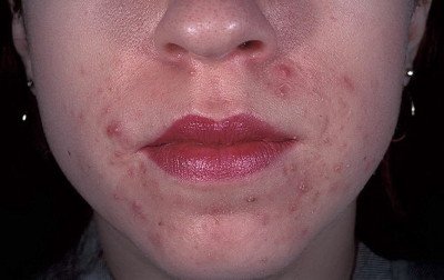 Жирна себорея на обличчі: лікування шкіри