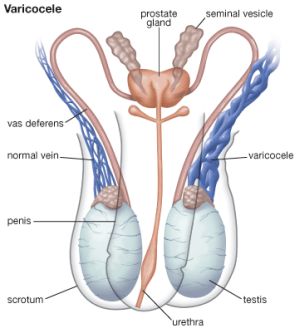 Варикоцеле у підлітків і чоловіків: причини, симптоми, лікування