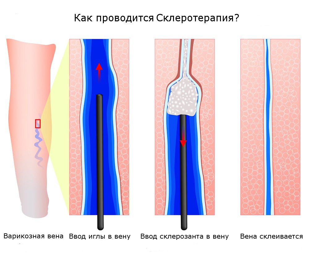 Склеротерапія вен нижніх кінцівок: види, показання, протипоказання, можливі ускладнення