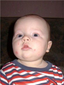 Червоні плями на шкірі у дитини: походження і лікування