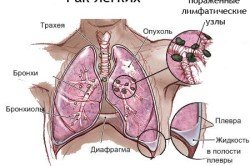 Операція при раку легенів