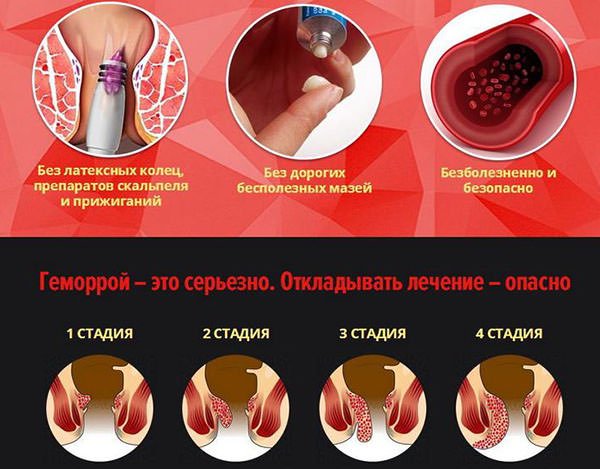 Якими народними методами геморой лікують жінки