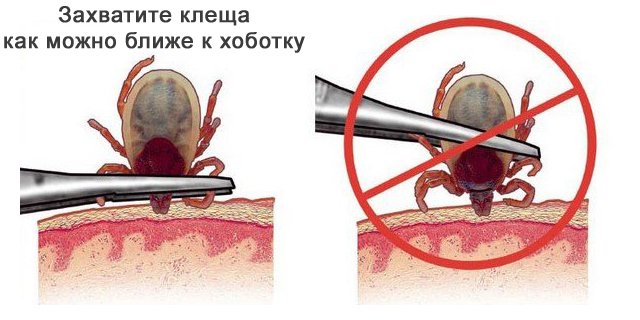 Що робити, якщо кліщ вкусив людини: перша допомога при укусі  