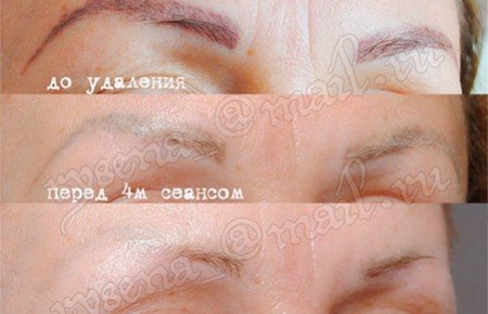 Видалення татуажу в салоні і в домашніх умовах