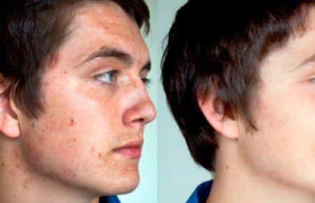 Механічна чистка обличчя: фото до і після, відгуки