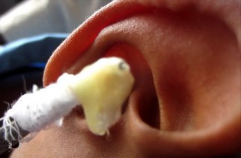 Зовнішній отит   причини, симптоми, методи лікування