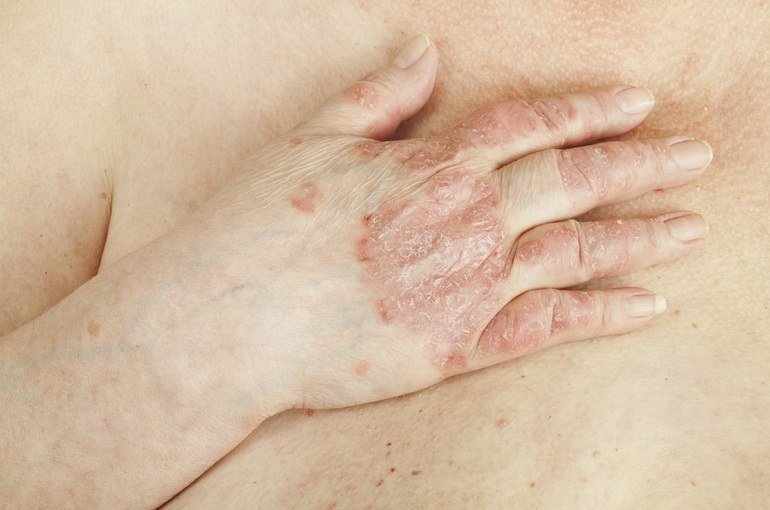 Лікування псоріазу гіпнозом   дослідження