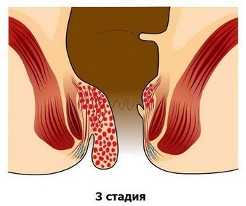 Стадії геморою, їх симптоми та лікування