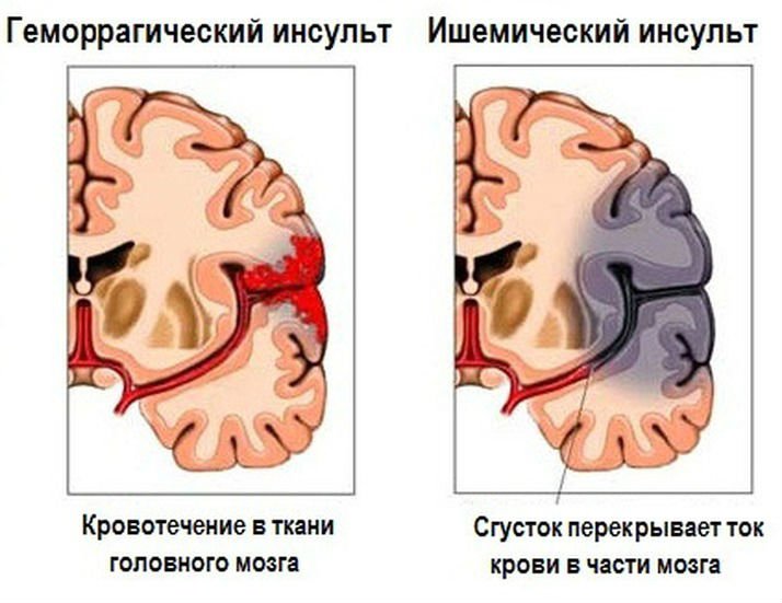 Інсульт правої сторони головного мозку : особливості та наслідки