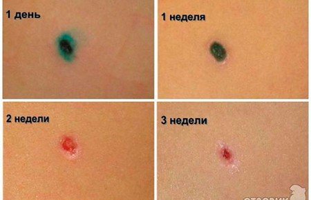 Видалення папілом в домашніх умовах Видалення папілом в домашніх умовах