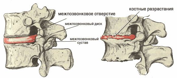 Спондильоз поперекового відділу хребта: симптоми і лікування