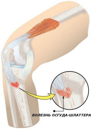 Чому виникає біль в коліні при ходьбі