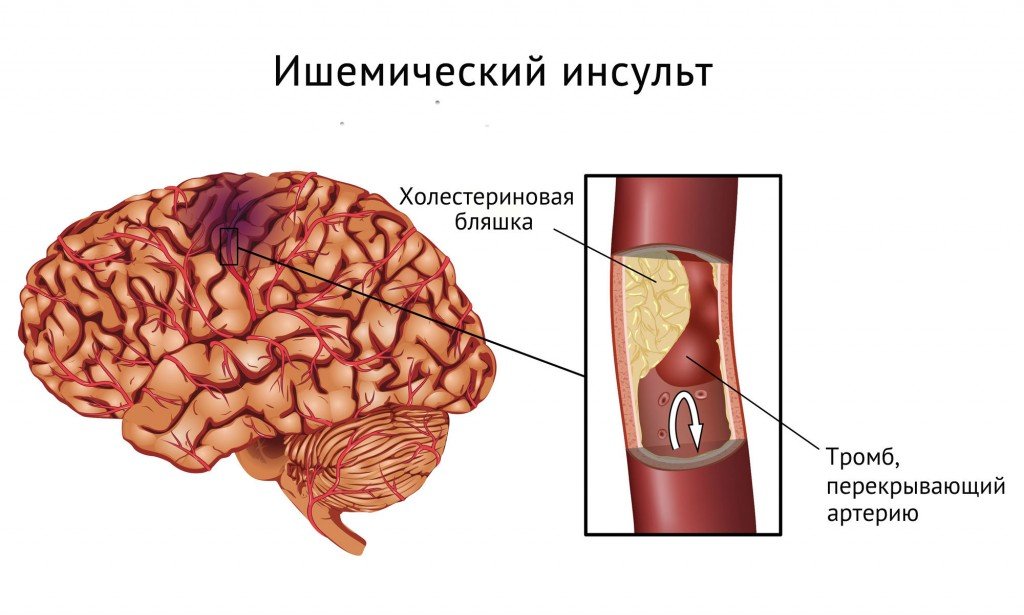 Що таке органічне ураження головного мозку, його симптоми та причини