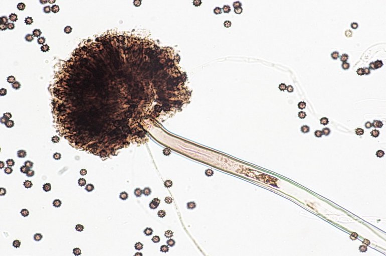 Отомикоз причини, симптоми, лікування Отомикоз причини, симптоми, лікування