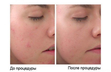 Ретиноевый пілінг: відгуки, фото до і після Ретиноевый пілінг: відгуки, фото до і після