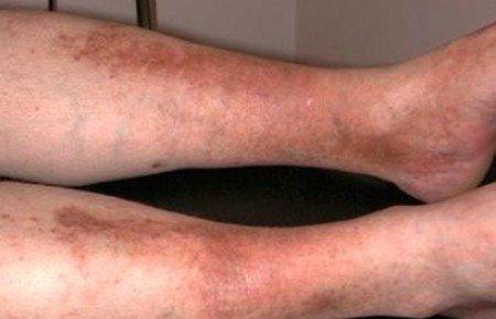 Пігментні плями на ногах: причини, фото, лікування