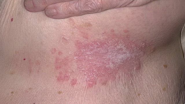 Грибок на тілі   типи грибка, симптоми, причини, профілактика