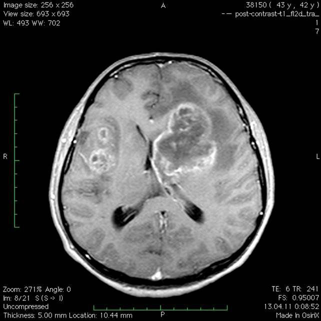 Глиобластома: причини, симптоми, види пухлини, діагностика і лікування