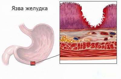 Що означає біль під лівою лопаткою