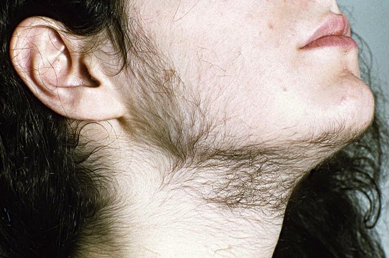 Гірсутизм   симптоми, причини і методи лікування