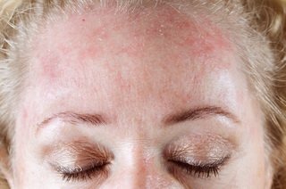 Трихомоніаз на голові   причини і лікування