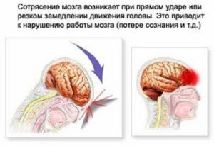 Струс головного мозку: симптоми і лікування