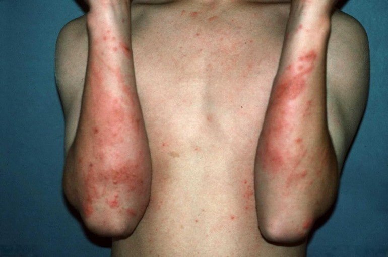 Контактний дерматит: причини, симптоми, лікування, фото Контактний дерматит: причини, симптоми, лікування, фото