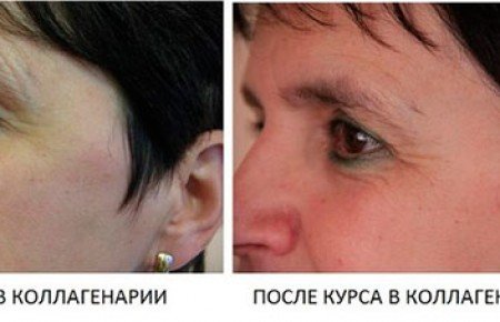 Коллагенарій: що це, показання, відгуки