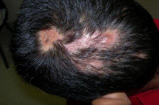 Трихомоніаз на голові   причини і лікування