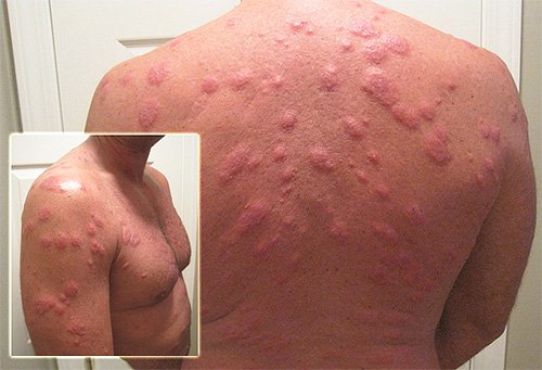 Алергія на укуси клопів, небезпечно це і як її лікувати