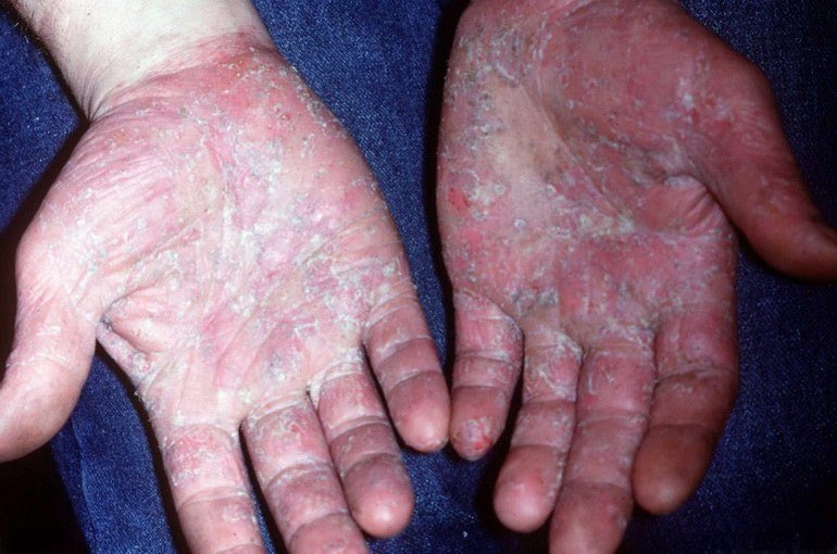 Контактний дерматит: причини, симптоми, лікування, фото