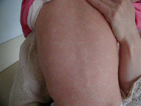 Алергія на мед: симпотомы, лікування і як проявляється (фото)