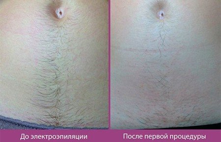 Електроепіляція: відгуки, протипоказання та наслідки
