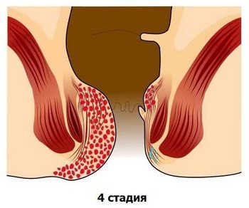 Стадії геморою, їх симптоми та лікування