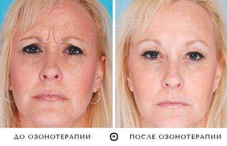 Озонотерапія для особи: відгуки, фото до і після