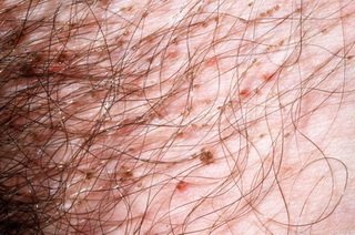 Трихомоніаз на голові   причини і лікування