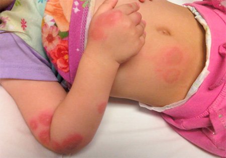Алергія на укуси клопів, небезпечно це і як її лікувати