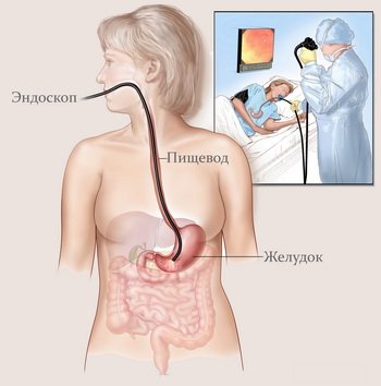 Езофагіт: причини, симптоми, лікування, профілактика