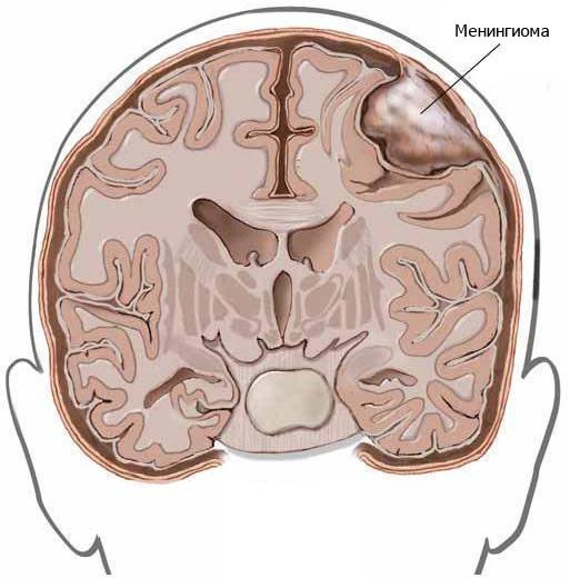 Менінгіома: класифікація пухлин, діагностика і лікування