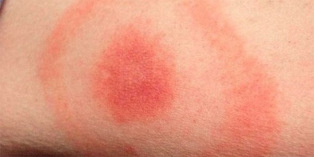 Хвороба Лайма або кліщовий бореліоз: симптоми, лікування, фото