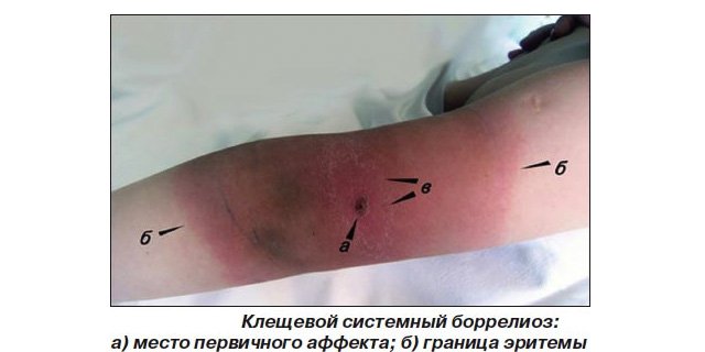 Хвороба Лайма або кліщовий бореліоз: симптоми, лікування, фото