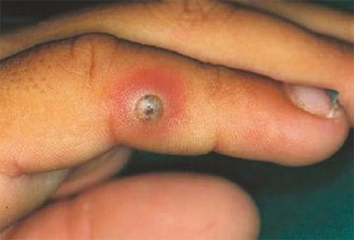 Піщані блохи у Вєтнамі і Таїланді (фото) і що важливо про них знати