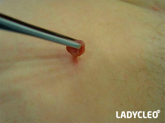 Видалення папілом в домашніх умовах Видалення папілом в домашніх умовах