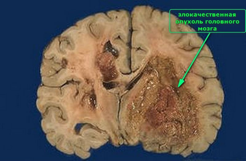 Рак головного мозку 4 стадії: ознаки, методи лікування та прогноз