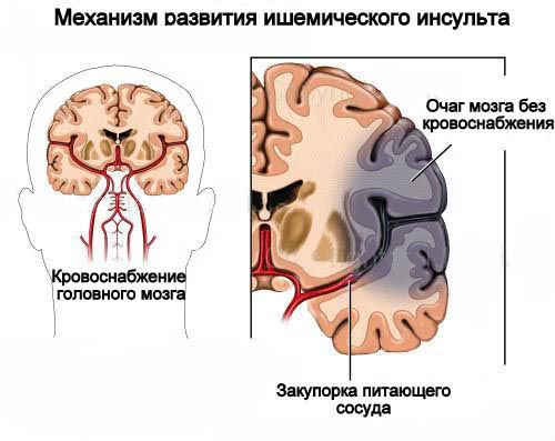 Лівобічний ішемічний інсульт: особливості та наслідки