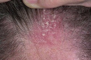 Трихомоніаз на голові   причини і лікування