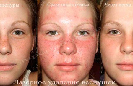 Видалення веснянок лазером: фото до і після, відгуки
