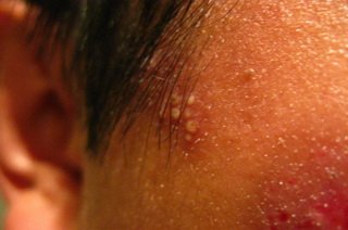 Трихомоніаз на голові   причини і лікування