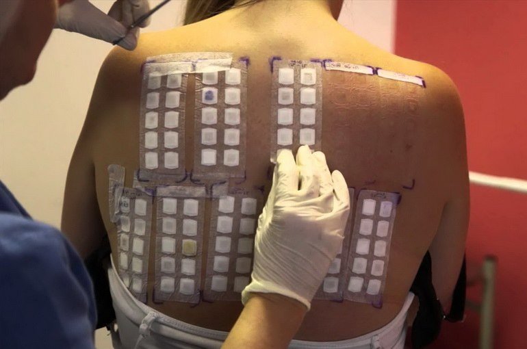 Контактний дерматит: причини, симптоми, лікування, фото