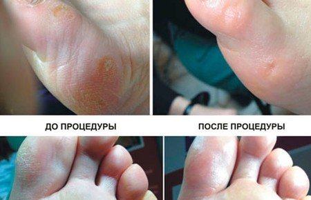 Апаратний педикюр: що це, відгуки, фото